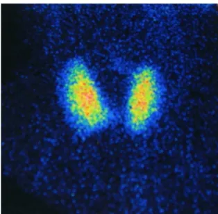 Figure 3: scintigraphie thyroïdienne montrant une hypertrophie    du lobe droit de contour moins régulier