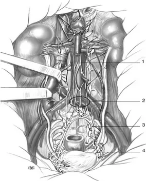Figure  9  Vue  antérieure  de  l‘innervation  rectale.  Le  fascia  pariétal  (ou  fascia  de  Gerota)a été retiré