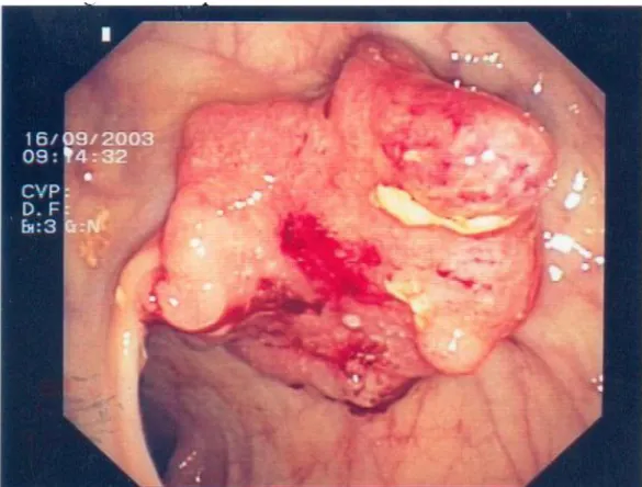 Figure 10 : Recto sigmoïdoscopie : cancer du rectum situé à 10 cm de la marge anale 