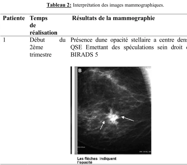 Tableau 2: Interprétation des images mammographiques.  Patiente  Temps  de  réalisation   Résultats de la mammographie  1  Début  du  2ème  trimestre 