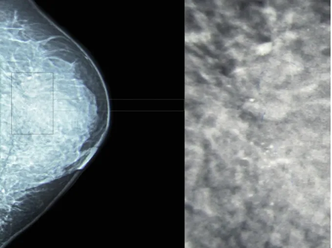 Figure 4 : Image  mammographique du sein gauche, vue de profil