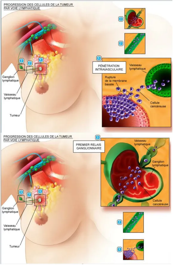 Fig 16 : Progression des cellules tumorales par voie lymphatique . 