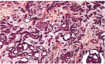Figure 3 : Patiente de 46 ans, avec un cancer du sein inflammatoire   Carcinome canalaire infiltrant,Grade III de SBR  