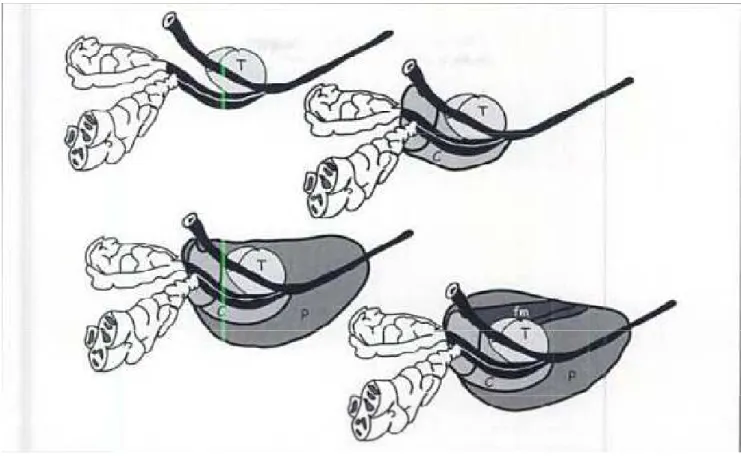 Fig8 : anatomie zonale de la prostate avec reconstitution autour des différents  structures canalaires (c : centrale ; p : périphérique ; T : transitoire) 