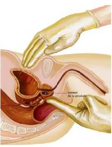 Figure 8 : la pratique du toucher rectal (Zemzdical.com/Isabell  Muller)