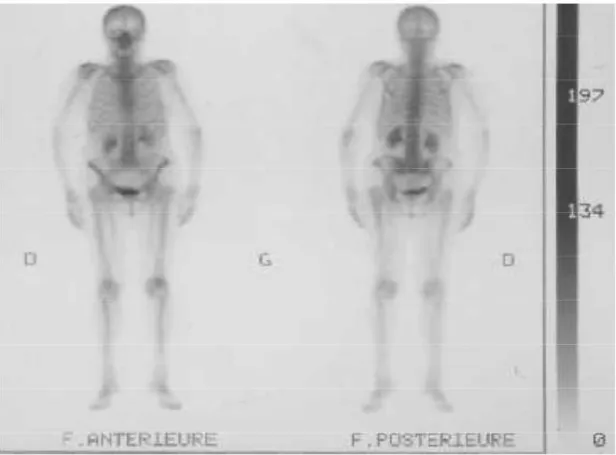 Figure 13  : scintigraphie osseuse normale 