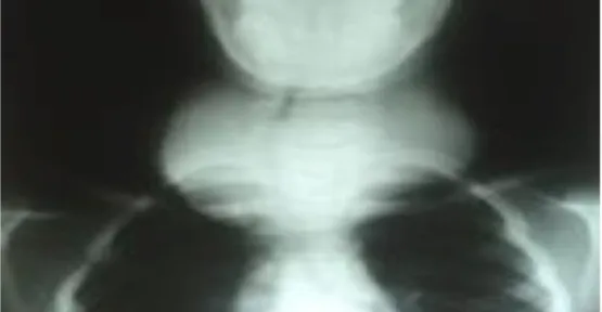 Figure 9: Radiographie du larynx de face 