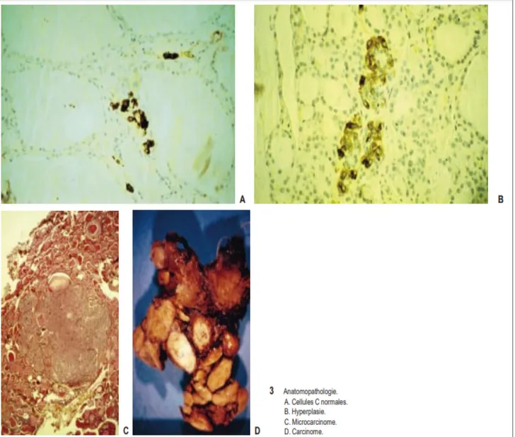 Figure 4 : Histoire naturelle du carcinome médullaire   familial de la thyroïde (Conte-Devolx B., 1999) 