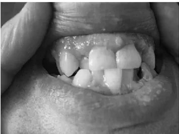 Figure 6 : papillomatose gingivale (Sardinoux M., 2010) 