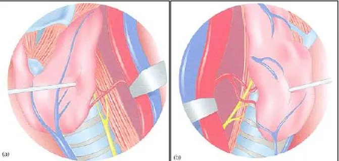 Figure 2 : repérage des nerfs récurrents (Evans P.H.R.M) 