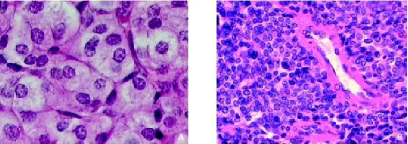 Figure 10: Carcinome médullaire thyroïdien, coloration HES (hématéine éosine  safran),Images à fort grossissement de l’aspect que peuvent revêtir les cellules 