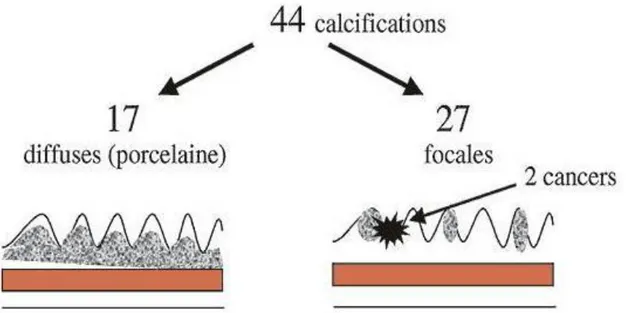 Figure 13 : schémas montrant les deux types de calcifications de la paroi  vésiculaire, prenant l’exemple de l’étude menée par Stephen AE au 