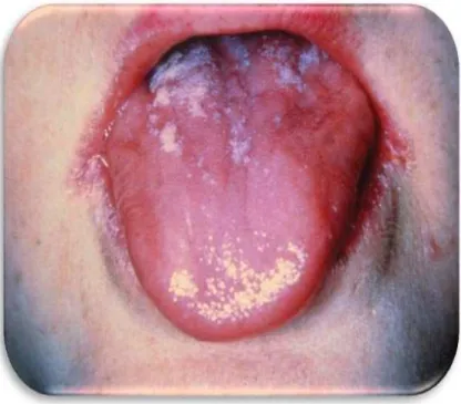 Figure 1 : :Infections bucco-dentaires :candidose chez un jeune enfant. 