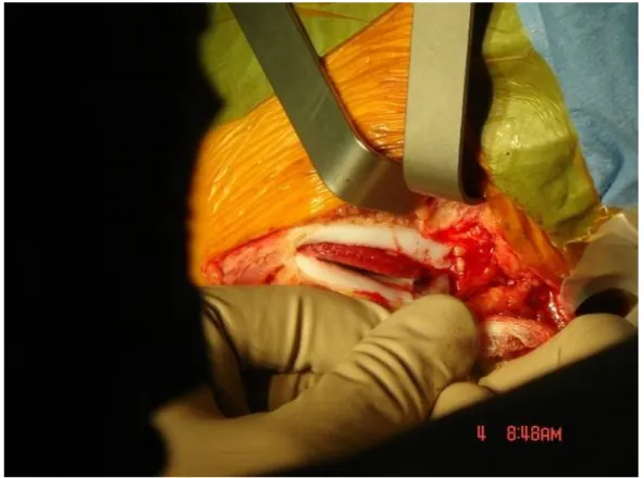 Figure 34: Dissection du cartilage de la crête iliaque.  
