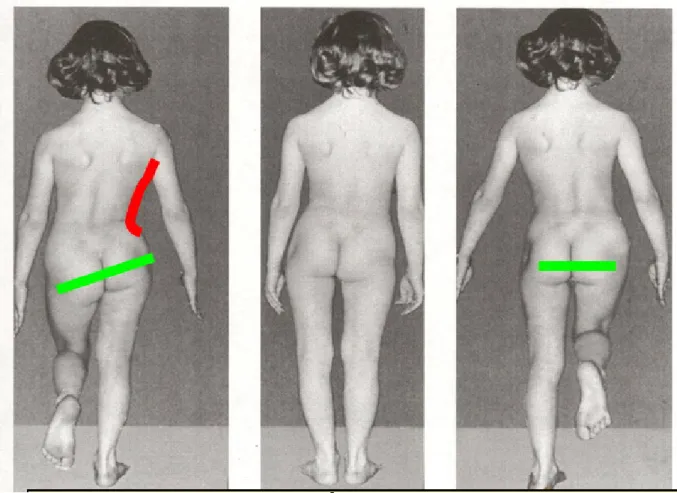 Figure 20: Signe de trendelenburg positive chez une fille de 4 ans atteinte   de luxation congénitale de la hanche droite