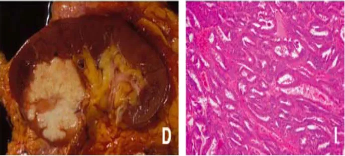 Figure 2 : Aspect macroscopique et microscopique du carcinome des tubes de Bellini  D : Tumeur de couleur blanc-grisâtre, mal limitée et nécrotique