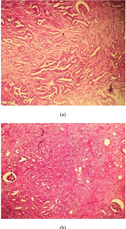 Fig . 5 (a, b) : Carcinome des tubes collecteurs (Bellini) : faible grossissement :  prolifération carcinomateuse faite de tubes de taille variable parfois adossés au sein 