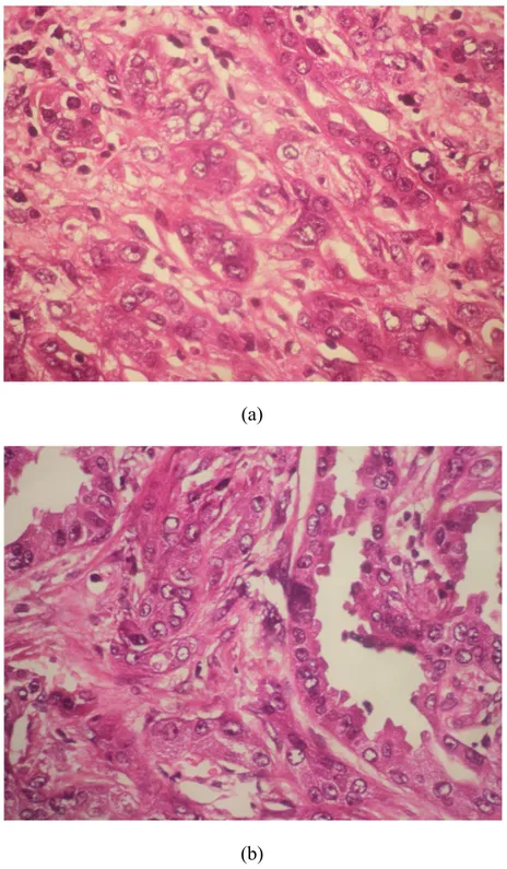 Fig. 6 (a, b) : carcinome de Bellini: fort grossissement : cellules tumorales qui tapissent  les tubes carcinomateux montrant des atypies cytonucléaires modérées parfois 