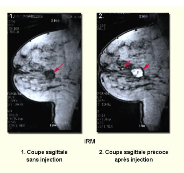Figure 14 :1. IRM Coupe sagittale sans injection : Image nodulaire à contours irréguliers