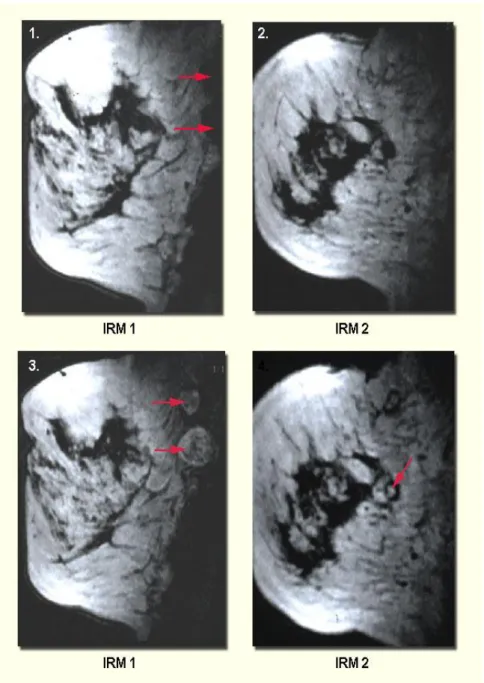 Figure 15 : IRM 1et 2, coupes sagittales avant injection 
