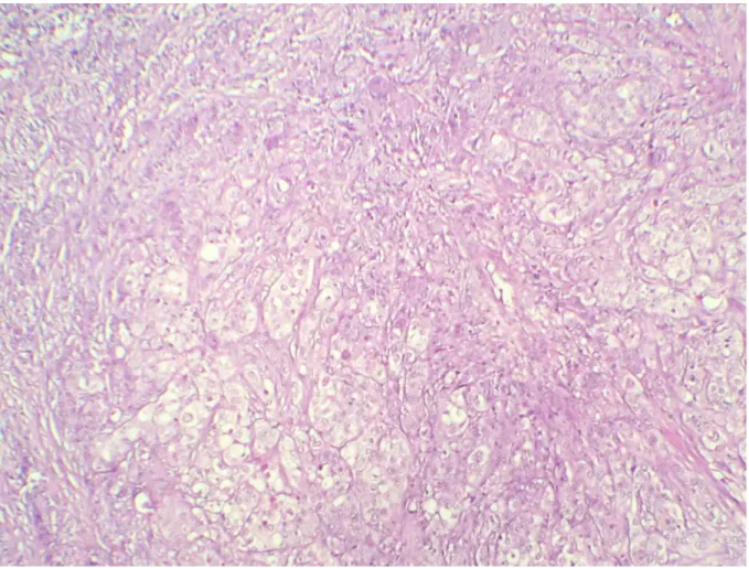 Figure 4 : prolifération tumorale carcinomateuse à différenciation malpighienne,  faite de lobules de taille variable (HE, Gx100) 