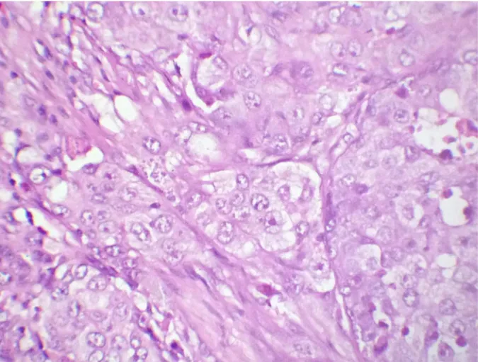 Figure 5 : les cellules tumorales sont de grande taille, munies d’atypies  cytonucléaires marquées et d’un nucléole proéminent (HE, Gx400) 
