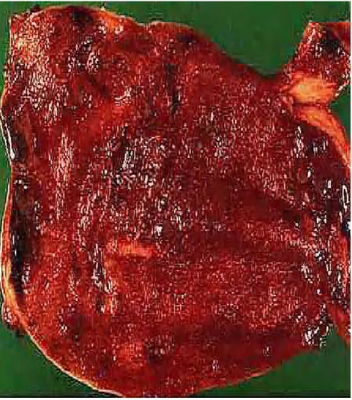 Figure 7 : Vésicule biliaire lithiasique avec des signes de cholécystite chronique. La  muqueuse est rouge inflammatoire, les calculs sont retirés après chirurgie [12] 