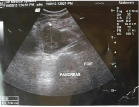 Figure 2:image échographique montrant un processus tumoral de la tête du pancréas 
