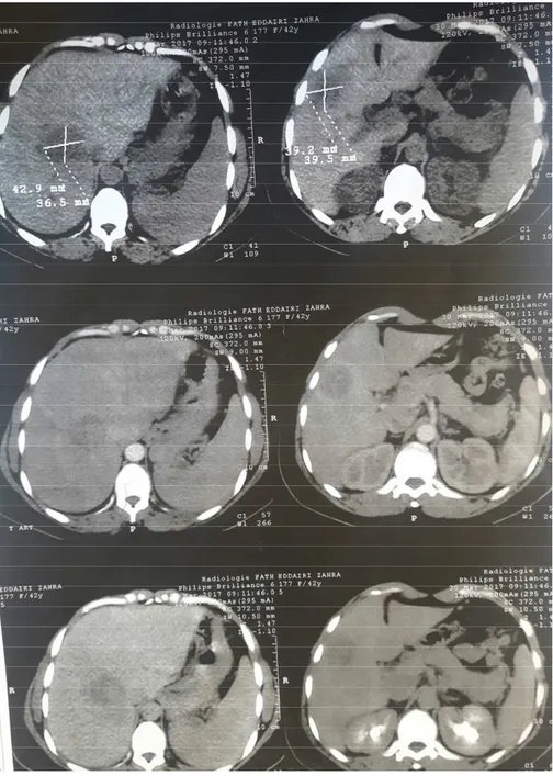 Figure 4:Image de TDM abdominale montrant un processus tumoral au niveau de la  tête du pancréas .