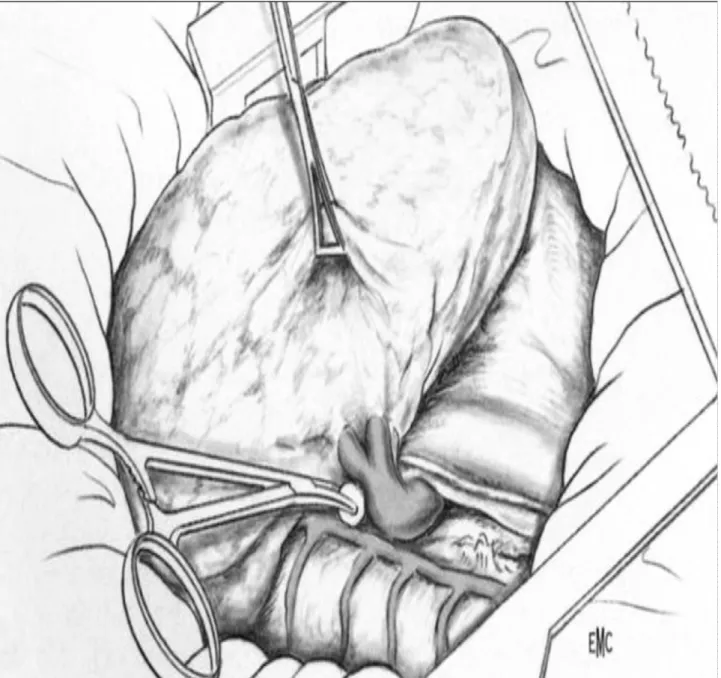 Figure 15 : La veine pulmonaire inférieure [3] 