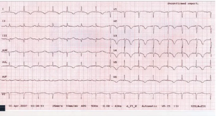 Figure 10: ECG à 48 h d’une patiente présentant un syndrome de Tako-tsubo [6] 