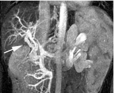 Figure 5 : thrombose et cavernome porte portal (flèche) reconstruction frontale de  l’angio-IRM [85] 