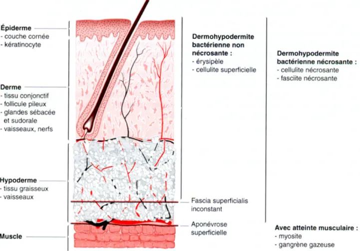 Figure 5 : Schéma montrant la structure de la peau et les différentes infections selon la  couche atteinte 