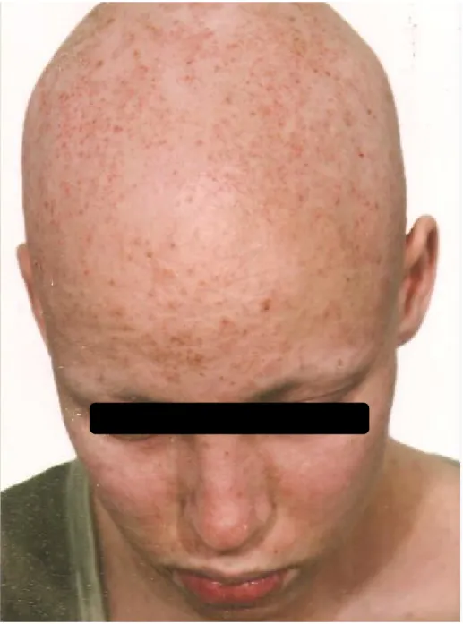 Figure 4 : Lésions papuleuses rougeâtres dont certaines sont excoriées   par le grattage siégeant au niveau de la tête 
