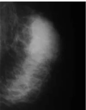 Figure 3  :  mammographie  oblique  gauche  chez  une  patiente  de  47  ans,  antécédent  chez  sa  sœur  à  48  ans,  sein  gauche  inflammatoire  avec  palpation  d’une  masse  supéro-externe  et  adénopathie axillaire suspecte
