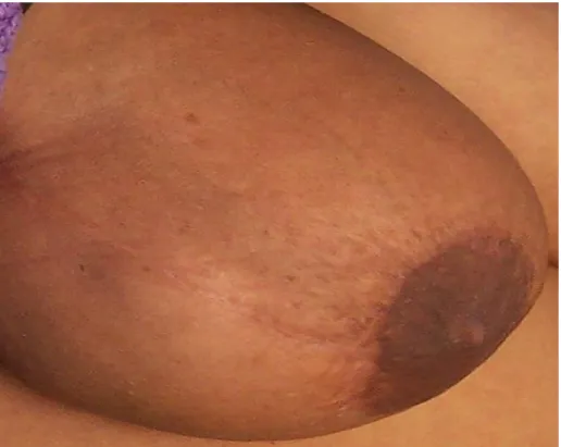 Figure 1 : photo montrant l’aspect d’un cancer de sein inflammatoire (T4d)  chez une femme de 54 ans