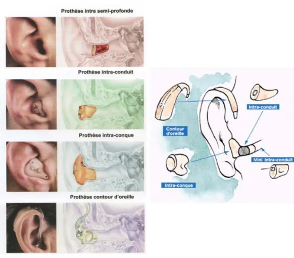 Figure 4 : Les prothèses auditives conventionnelles : contours d’oreille et intra-auriculaires  (www.orl.nc) 