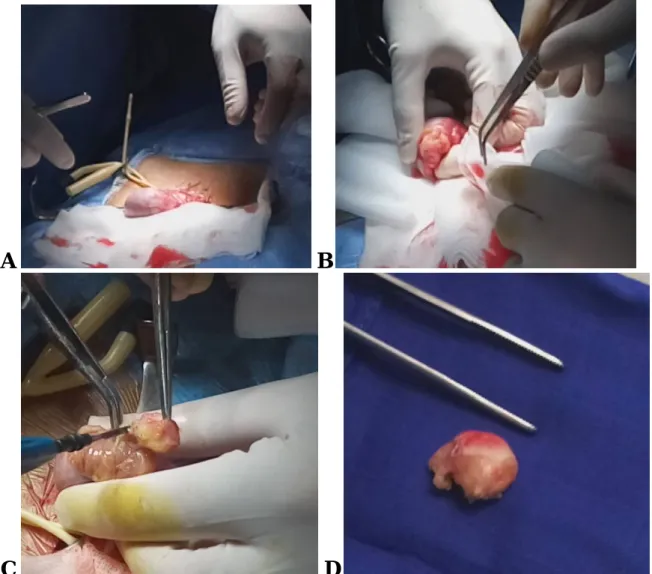 Fig. 7 : (A) Clampage préalable du cordon. (B) Enucléation de kyste après l’incision de  l’albuginée