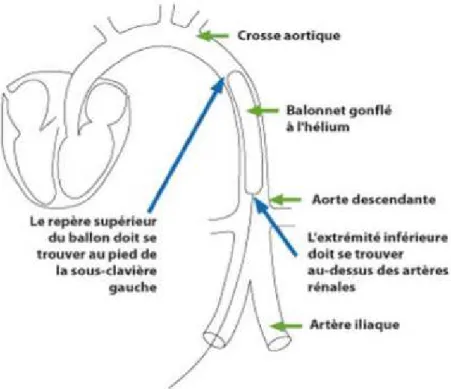 Figure 10 : ballon de contre pulsion intra-aortique [36]. 
