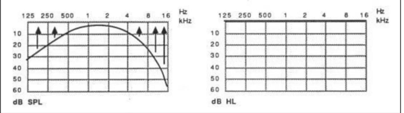 Figure 3 : Conversion des dB physiques dB SPL en dB audiométriques dB HL 