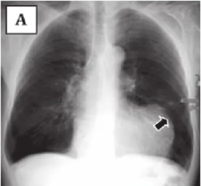 Figure 5: La radiographie pulmonaire révélant une déformation   marquée de la frontière ventriculaire gauche (flèche) (90) 