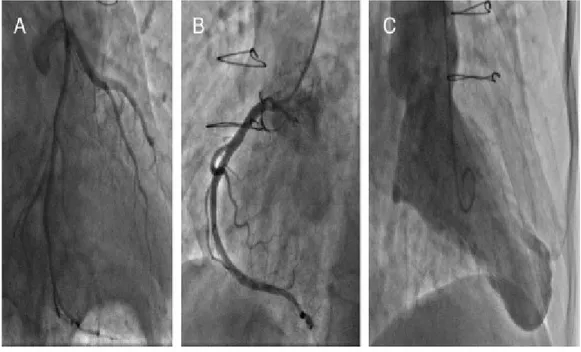 Figure 8: Les angiographies coronaires d'un patient montrant à la fois à gauche (A) et à droite  (B) des artères coronaires normales et son ventriculogramme gauche (C) montrant un anévrisme 