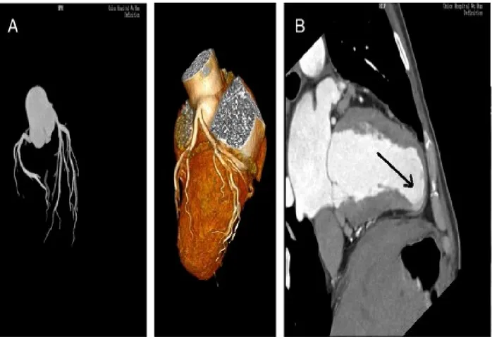 Figure 9: La tomodensitométrie angiographique coronarienne du même patient montrant les  artères coronaires normales (A) et un anévrisme du ventricule gauche apical (flèche en B) (25)