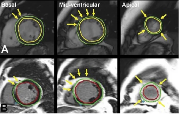 Figure 11: IRM d'axe court des tranches au niveau basal, mi ventriculaire, et apical: (A) pour  l'évaluation épaisseur de paroi du ventricule gauche (VG), en utilisant des acquisitions en écho  de gradient, et (B) pour l'analyse de la cicatrice myocardique