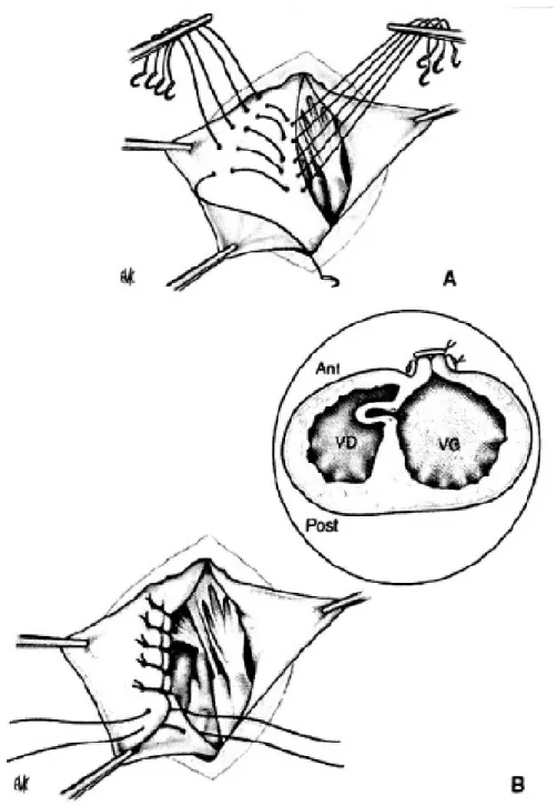 Figure 133: Anévrisme ventriculaire gauche, technique de résection linéaire avec plicature  septale (technique de Cooley)