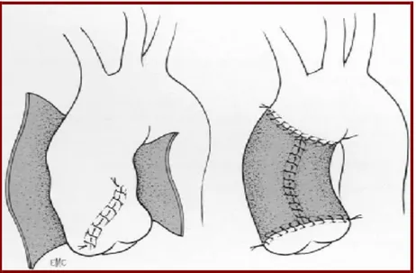 Fig. 19: technique d’enveloppement de l’aorte ascendante. 