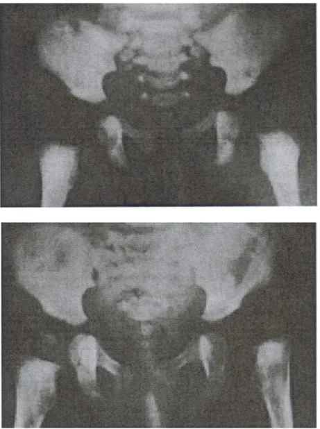 Figure 9: Radiographie d'un bassin : normal à la naissance (en haut) avec luxation  évidente de la hanche gauche à trois mois (en bas)