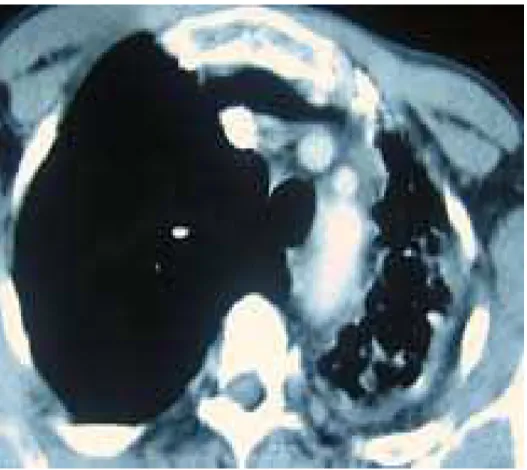Figure 6 : Image scanographique montrant un poumon gauche détruit. 