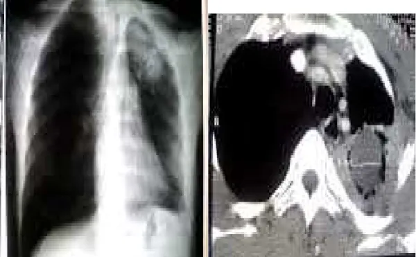 Figure 7 : Aspergillome du lobe supérieur gauche. .(Service de chirurgie  thoracique Avicenne) 