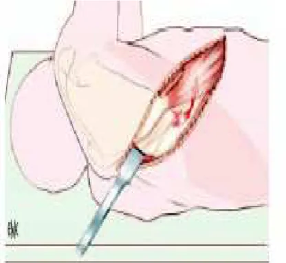 Figure 14 :Ouverture du triangle rhomboidoserratique. 